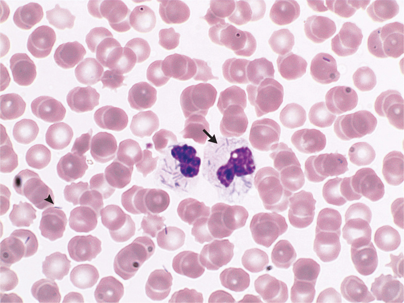 Case Of Capnocytophaga canimorsus Infection In 62YearOld