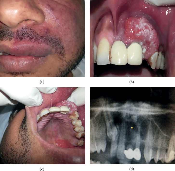 Peripheral Ameloblastoma In Upper Gingiva In 37YearOld