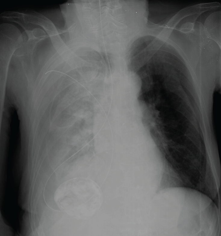 A Misplaced Nasogastric Tube! MEDizzy Journal