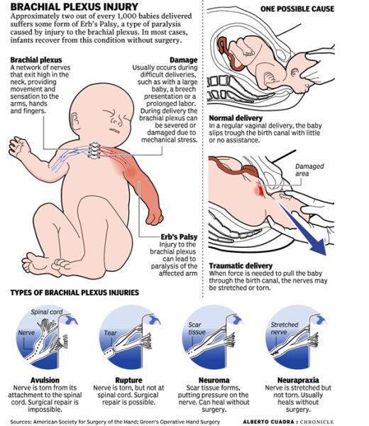 Erb’s Palsy or Waiter’s Tip Hand In The Neonates MEDizzy Journal