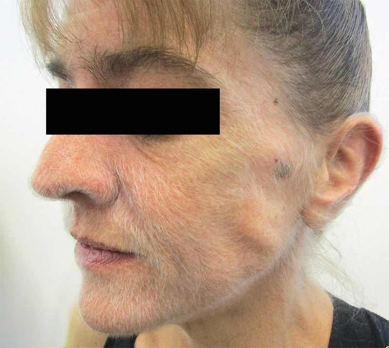 Excessive Hair Growth A Sign of Cancer! MEDizzy Journal