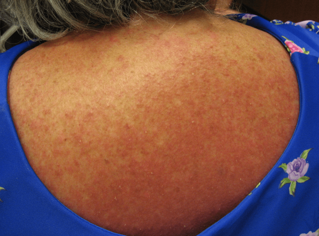 ClozapineInduced DRESS Syndrome in 32YearOld