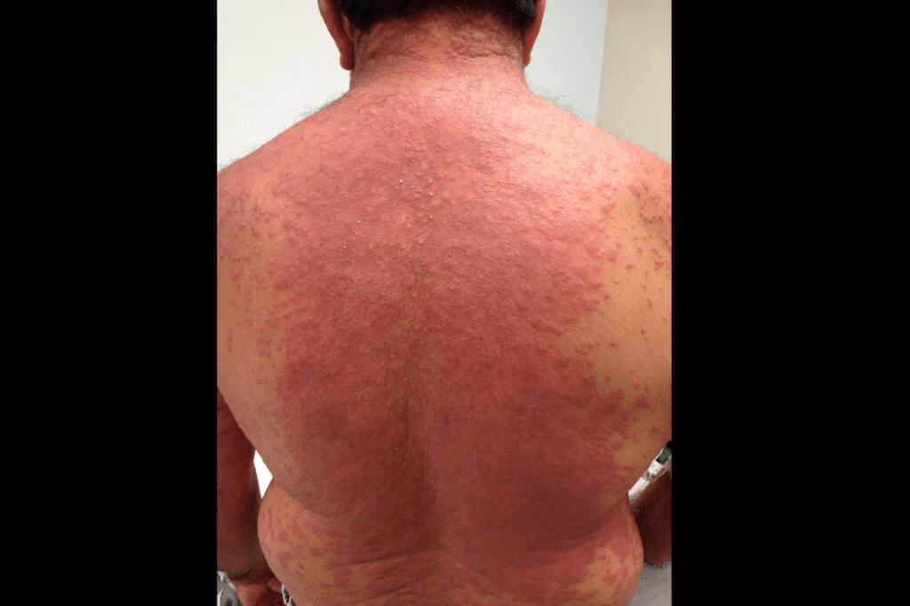 DRESS Syndrome Rare Acute Dermatologic Emergency