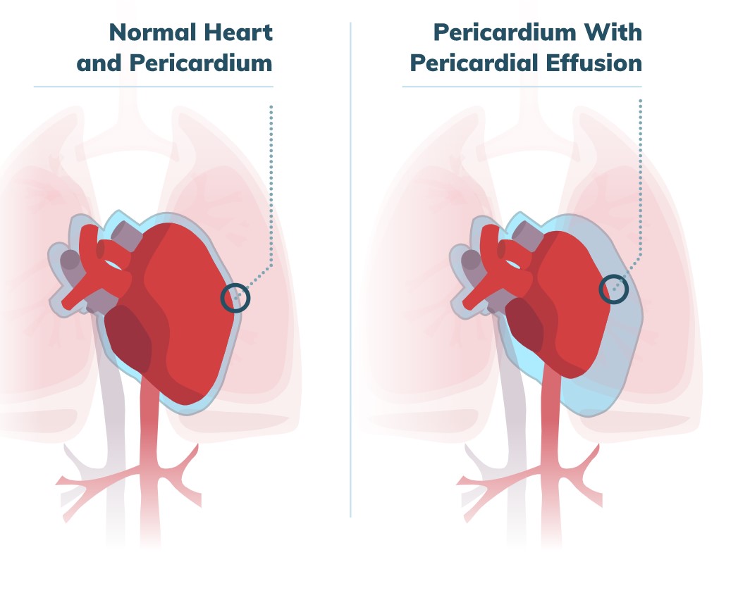 Sixty Millilitres of Fluid Around the Heart! MEDizzy Journal