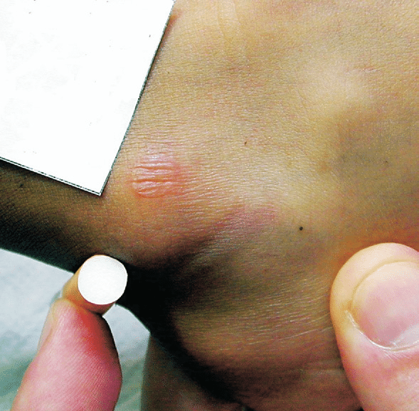 Case of child abuse caused by cigarette burns