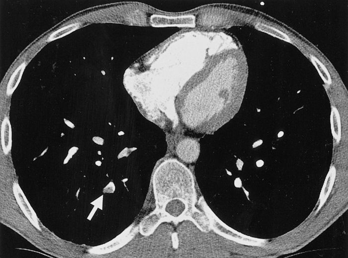Pulmonary Embolism