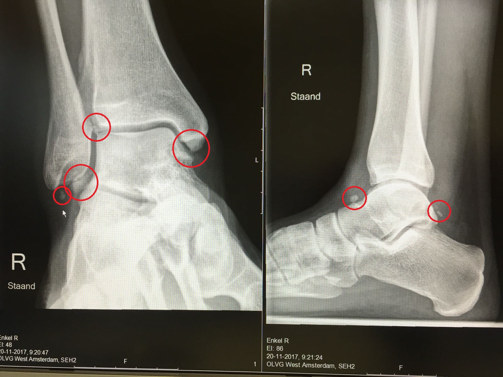 Icd 10 Cm Code For Bilateral Ankle Swelling