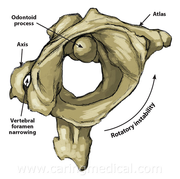 Upper Cervical Instability of Traumatic Origin Treated with Dextrose