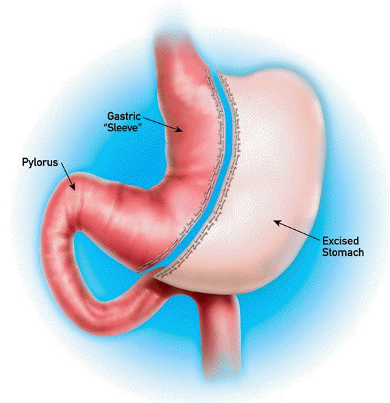 Gastric sleeve (sleeve gastrectomy or VSG) with Dr. Trace Curry in Cincinnati, Columbus, and
