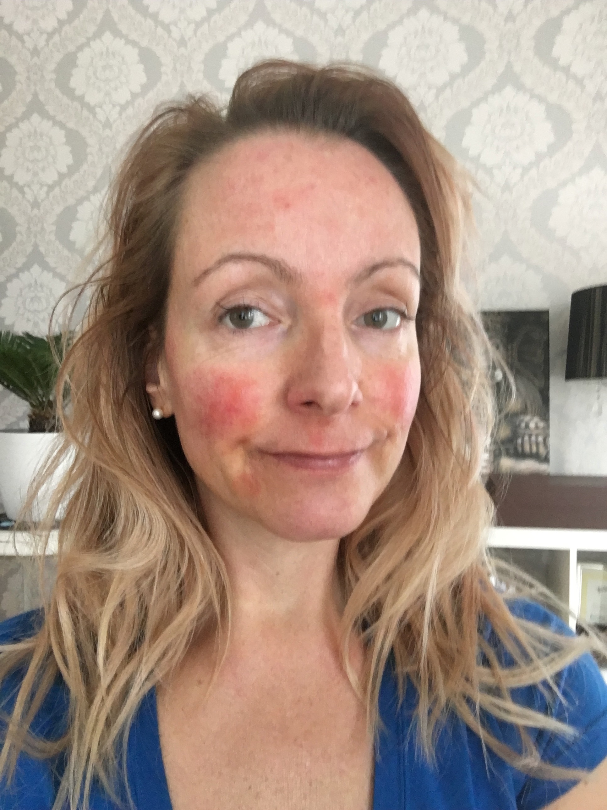 My 30Day Medical Medium Celery Juice Challenge & Resulting Skin Crisis