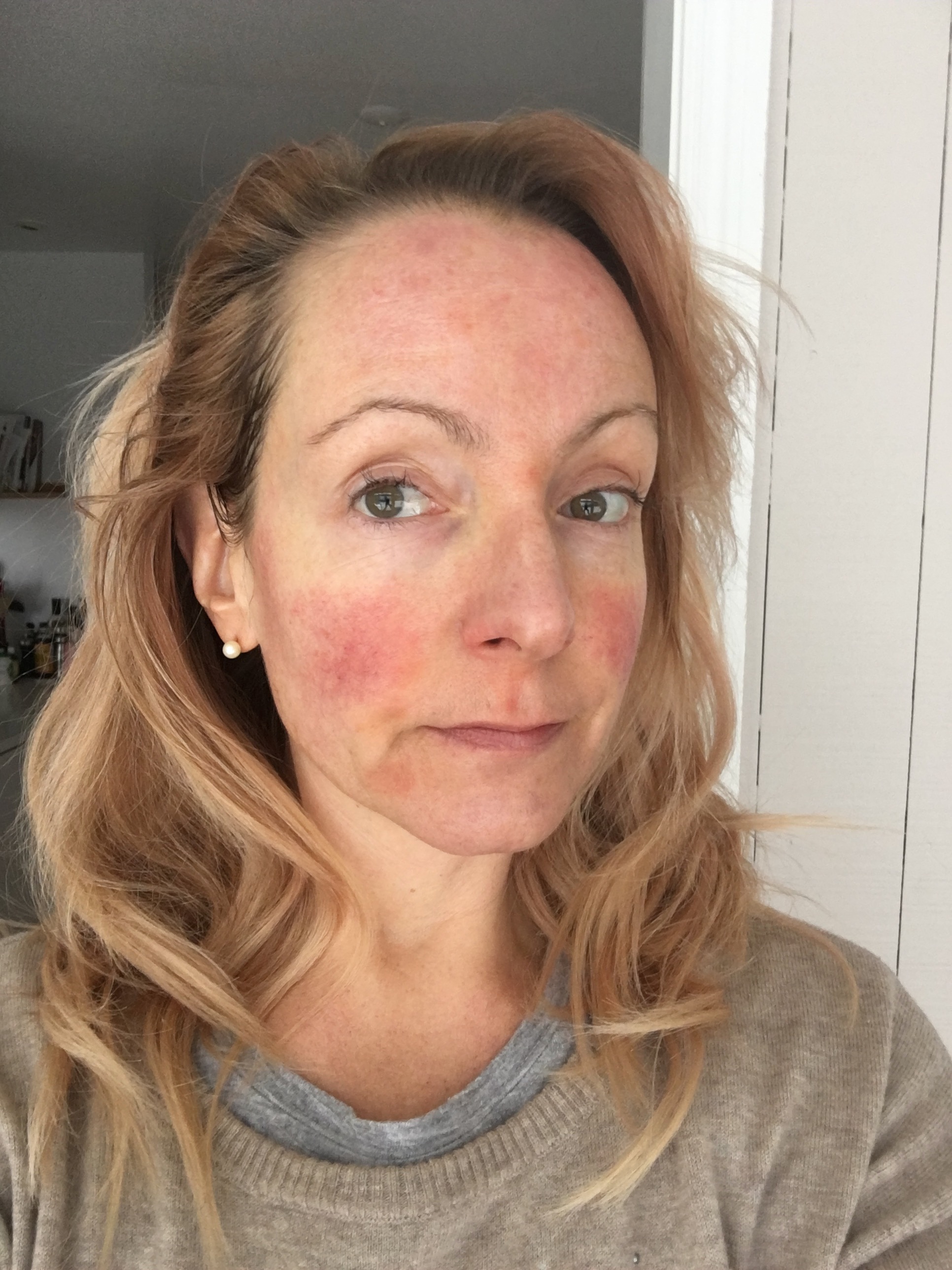 My 30Day Medical Medium Celery Juice Challenge & Resulting Skin Crisis