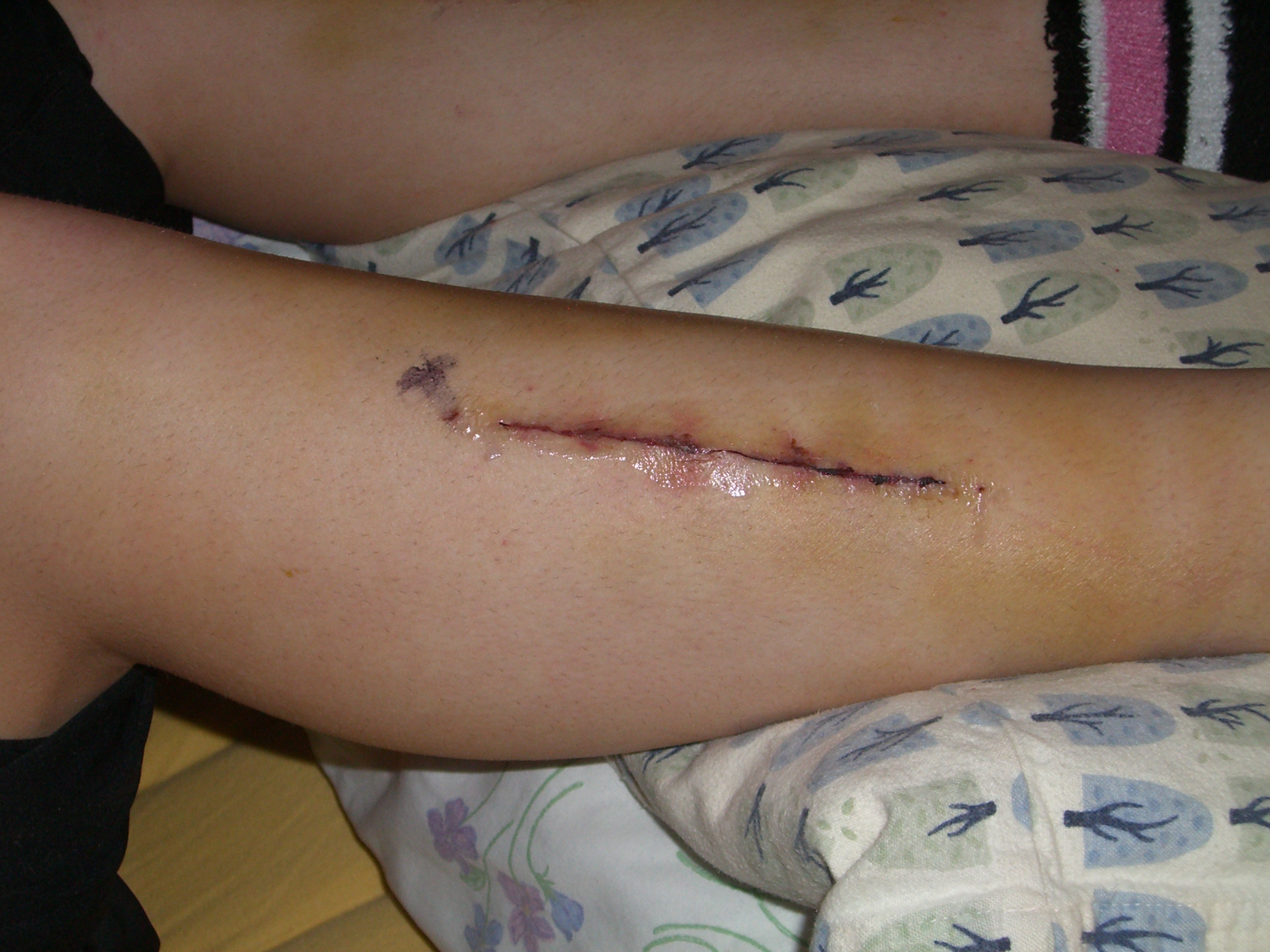hematoma leg DriverLayer Search Engine