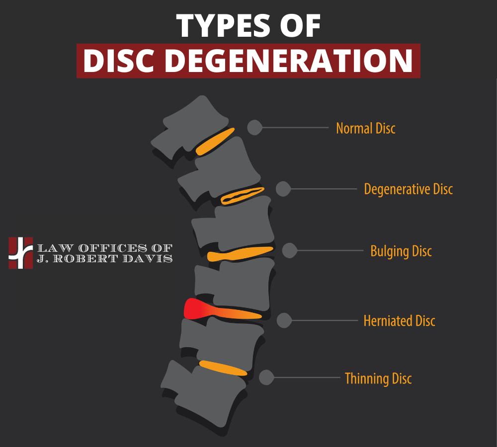 Herniated Disc Injury Settlements With Steroid Injections
