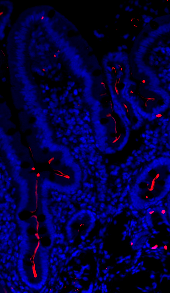 CFTR (human disease) Turner Lab