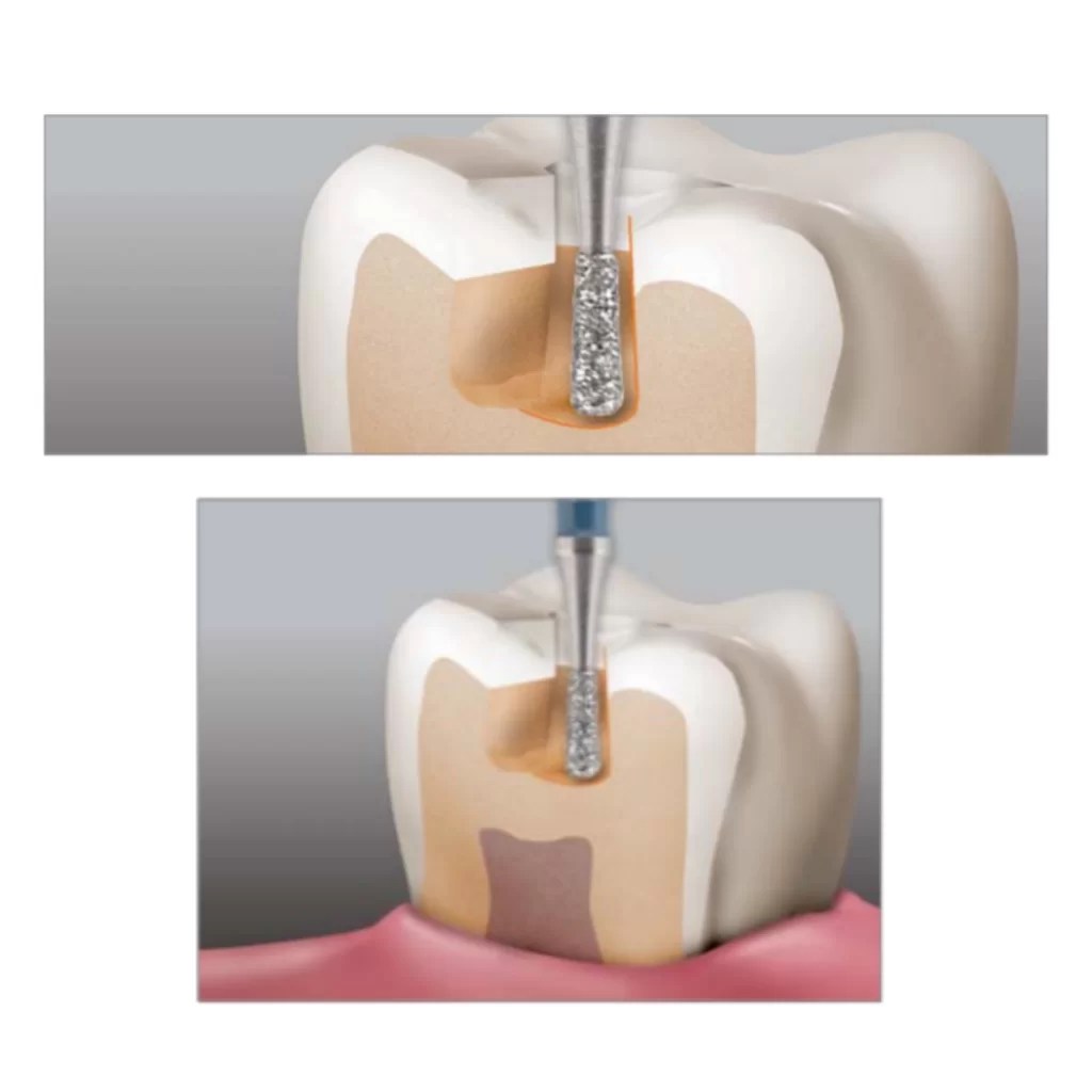 Diamond Bur Pear J&S Davis