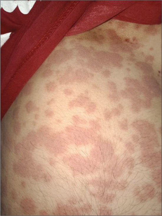 Atypical maculopapular rash as the initial sign of COVID19 A case