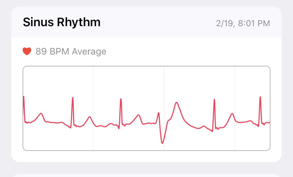 The Apple Watch's ECG Helped My Wife