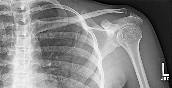 Man with blow to shoulder Page 2 of 2 Journal of Urgent Care Medicine