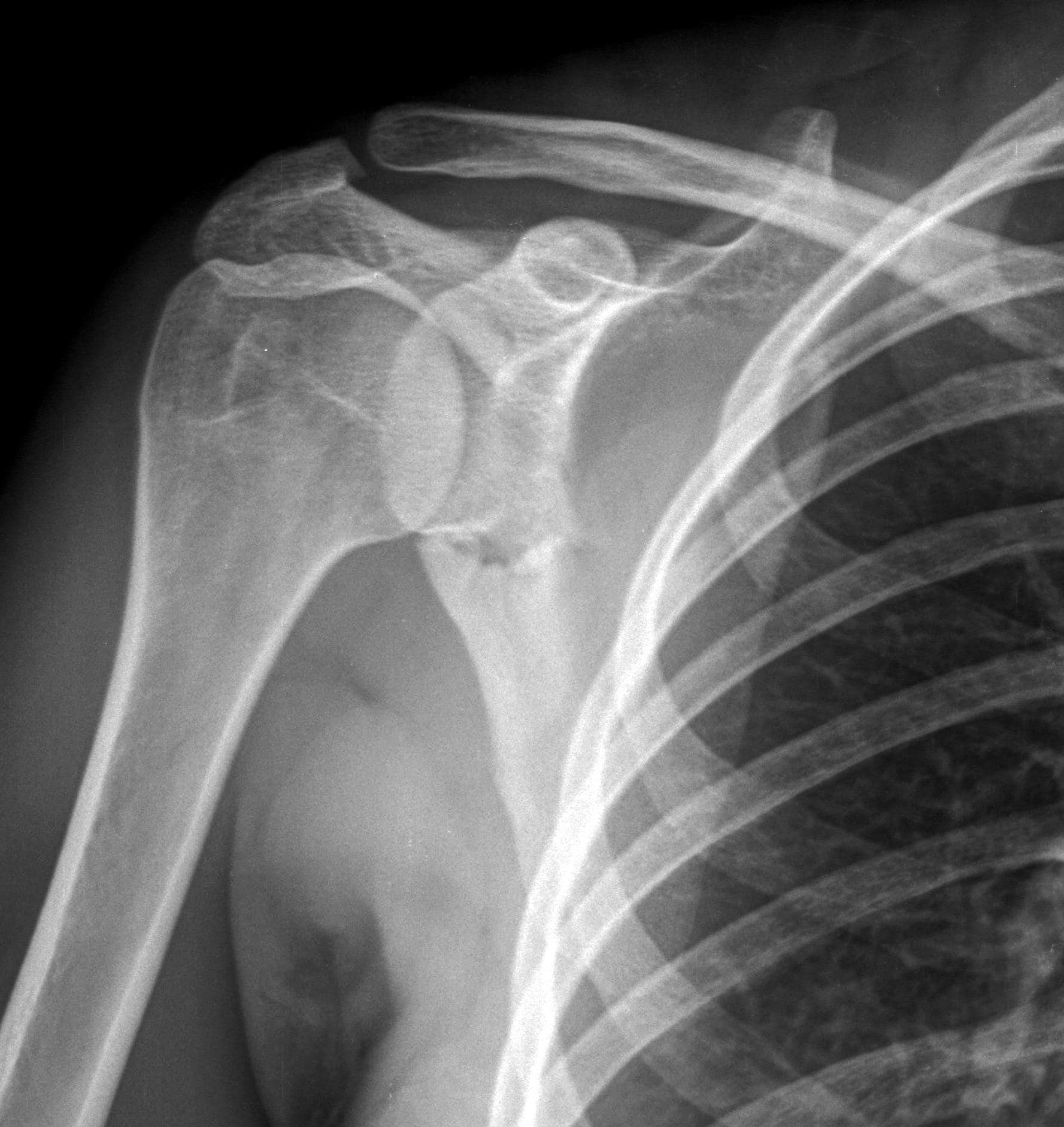 21yearold man with a blow to his right shoulder Journal of Urgent