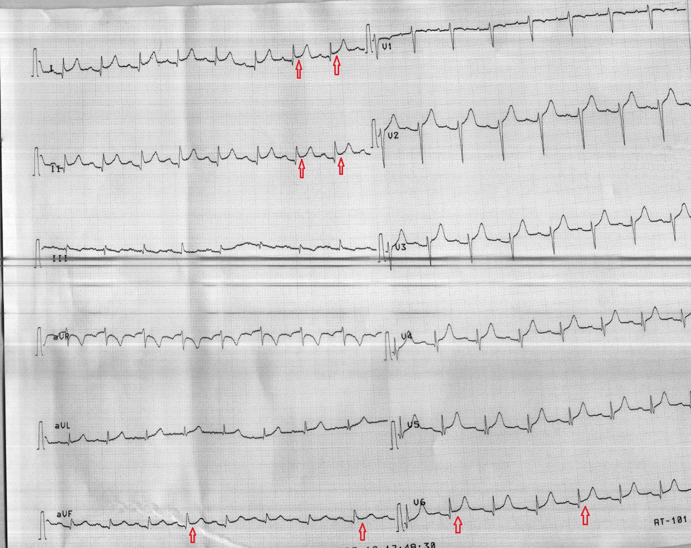 EKG taken of 57yearold woman with chest pain Page 2 of 2 Journal
