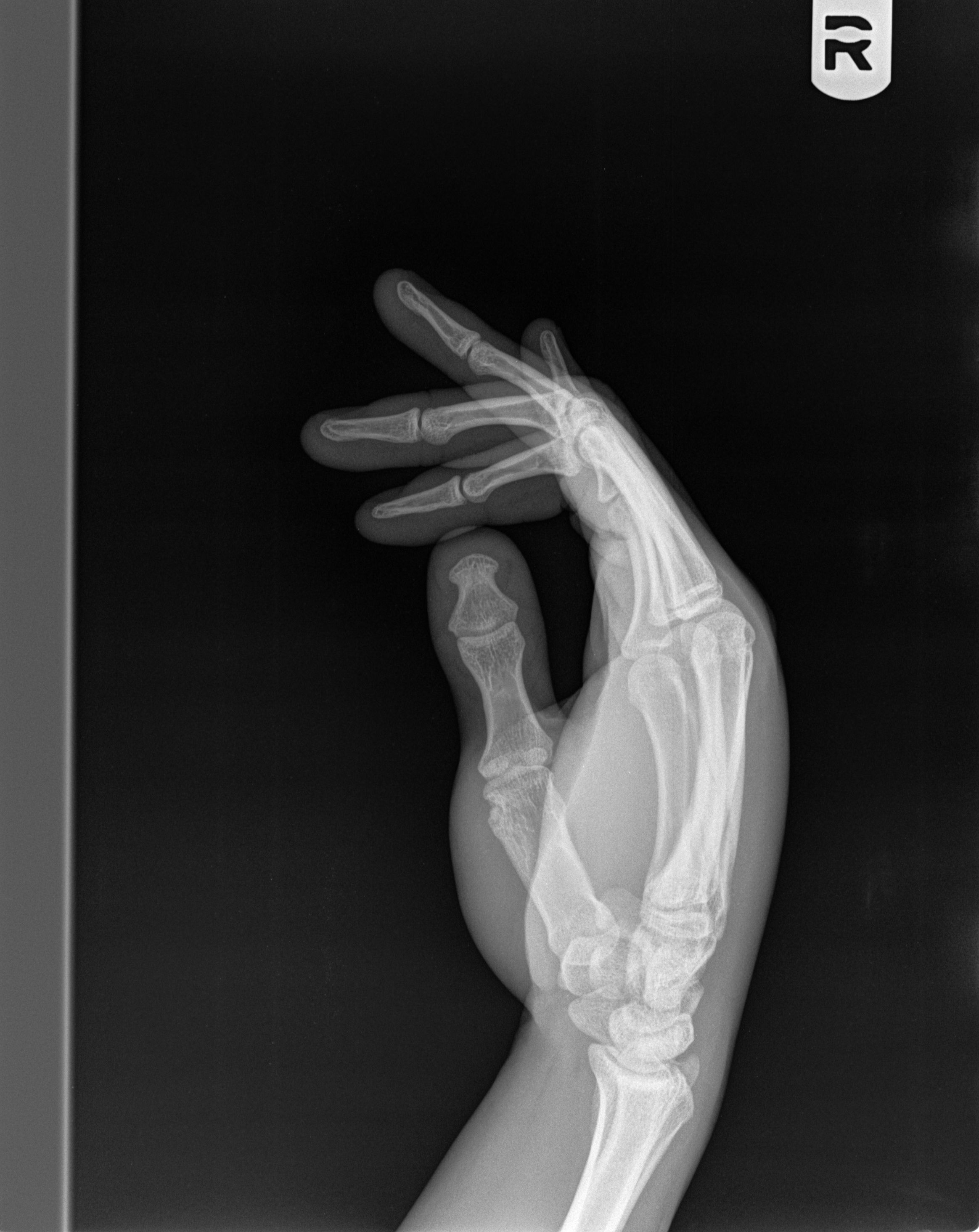Xray of man with a crush injury to hand Journal of Urgent Care Medicine