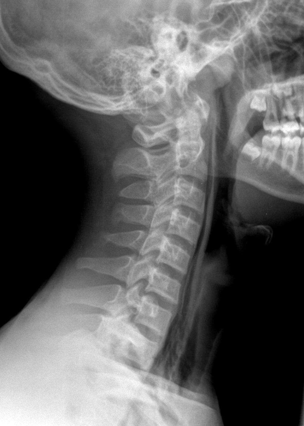 16yearold male experiencing chest and throat pain