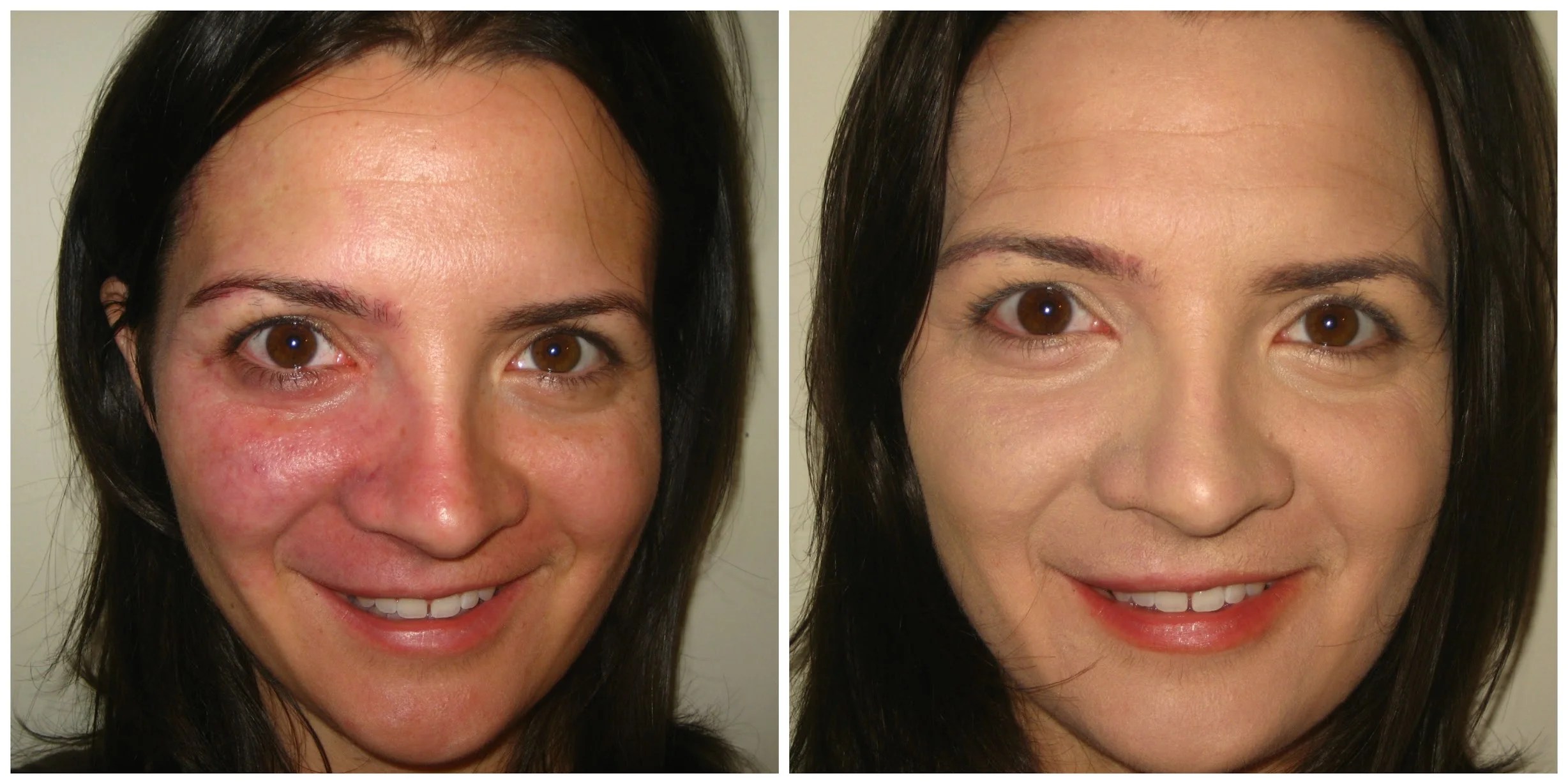 Makeup To Cover Birthmark or Portwine Stain Judith August Cosmetics