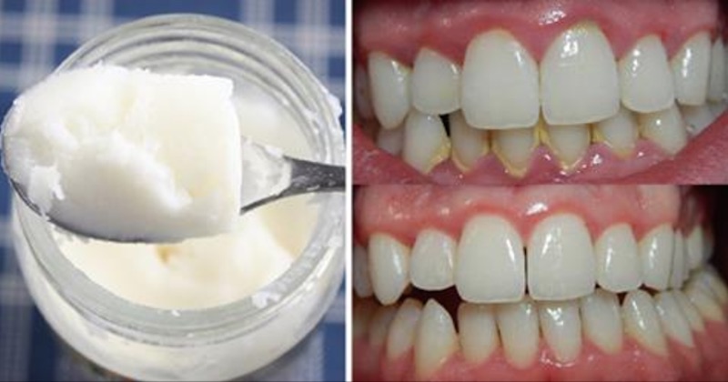 Oil Pulling Benefits Stop Bad Breath, Plaque And