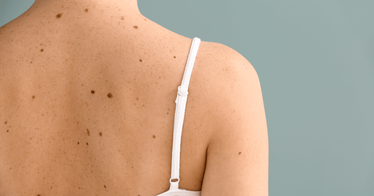 Skin Cancer Screening What You Should Know