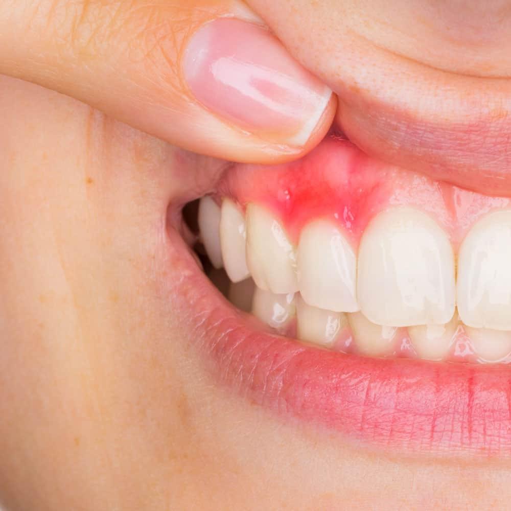 Root Canal Treatment When You Need It? Home