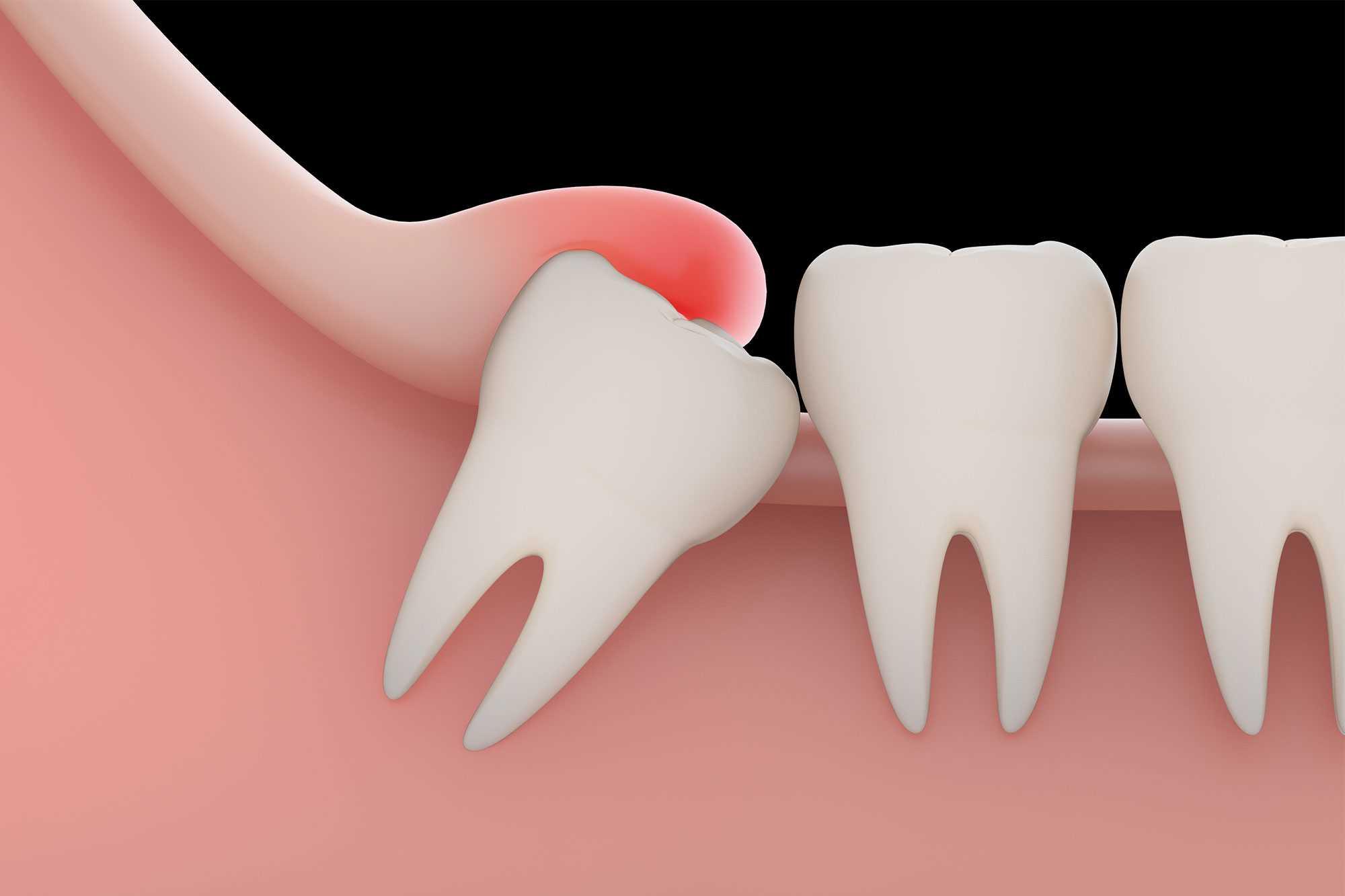 What Should We Do About Wisdom Tooth Pain? Home