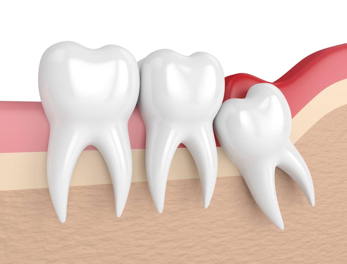 What Do You Know About Wisdom Tooth Extraction? Blogs Dental, LLC