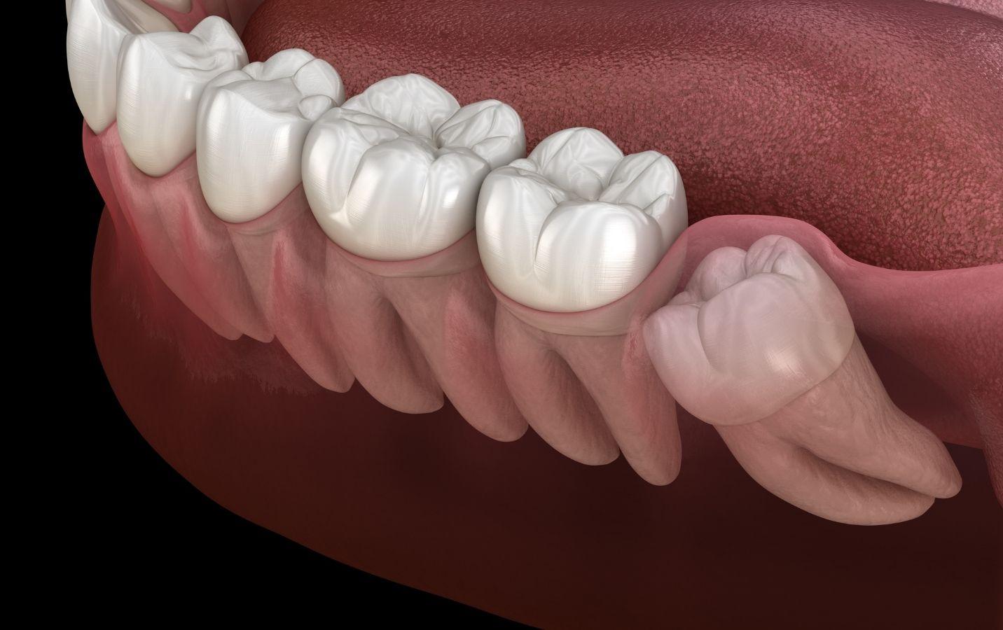 How Do Wisdom Teeth Infections Occur? Blogs Dental, LLC