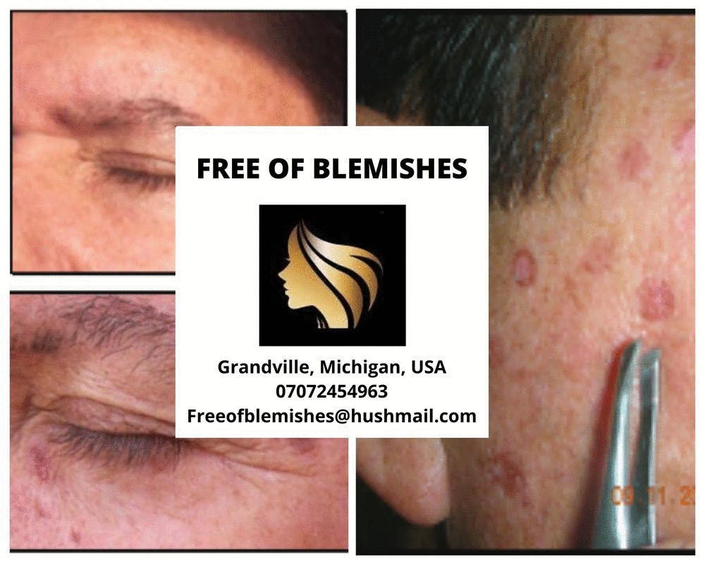 Professional blemish removal JustPaste.it