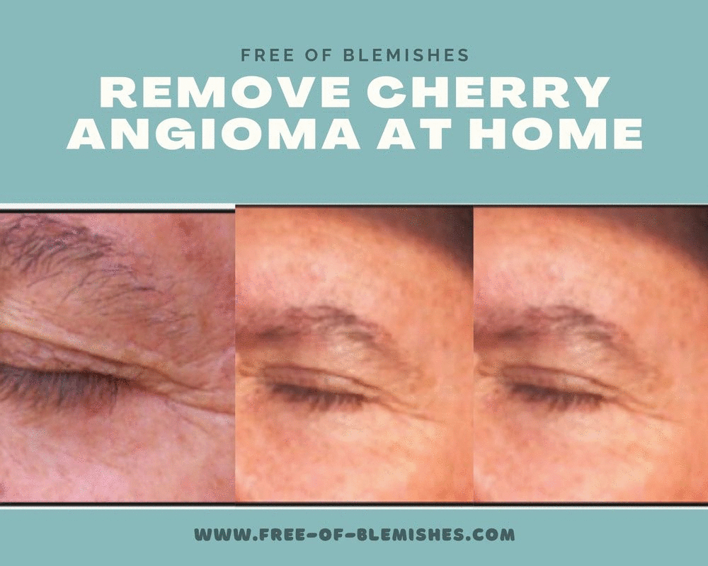 Remove Cherry angioma at home JustPaste.it
