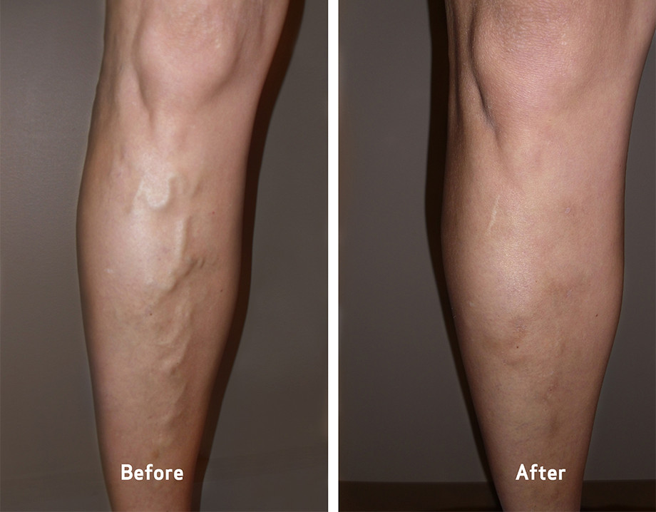 What are the types of varicose veins?