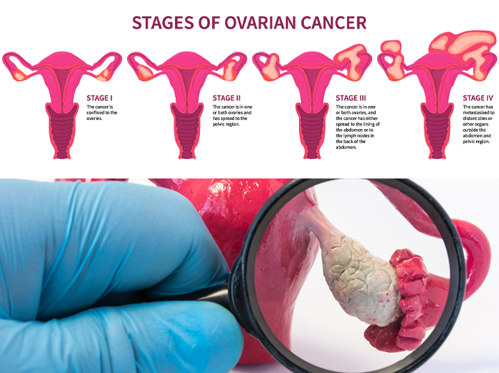 Ovarian Cancer early warning signs, Causes & Treatments All about