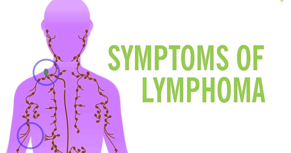 Lymphoma (Cancer of the Lymphatic System) Causes, Symptoms