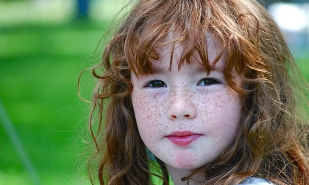 Understanding Freckles Cause, Prevention & Treatment All about your