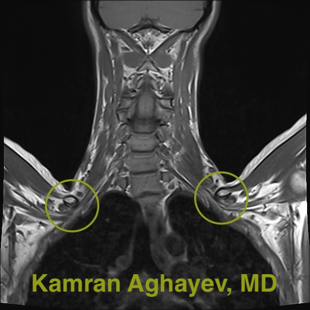 What is Thoracic Outlet Syndrome Kamran Aghayev, MD