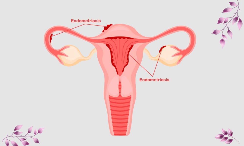 Endometriosis Symptoms, Causes & Treatment Kangaroo Care Fertility