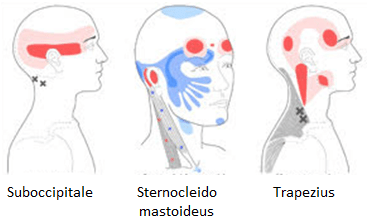 Hoofdpijn Therapie – Kanjer Fysiotherapie
