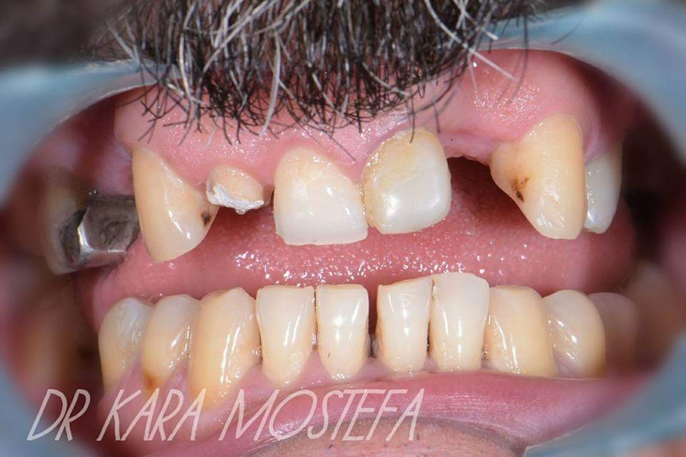 Photos avant après traitement de dentiste Photos avant après traitement de dentiste