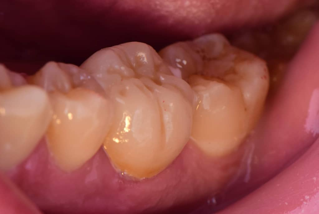 Photos avant après traitement de dentiste