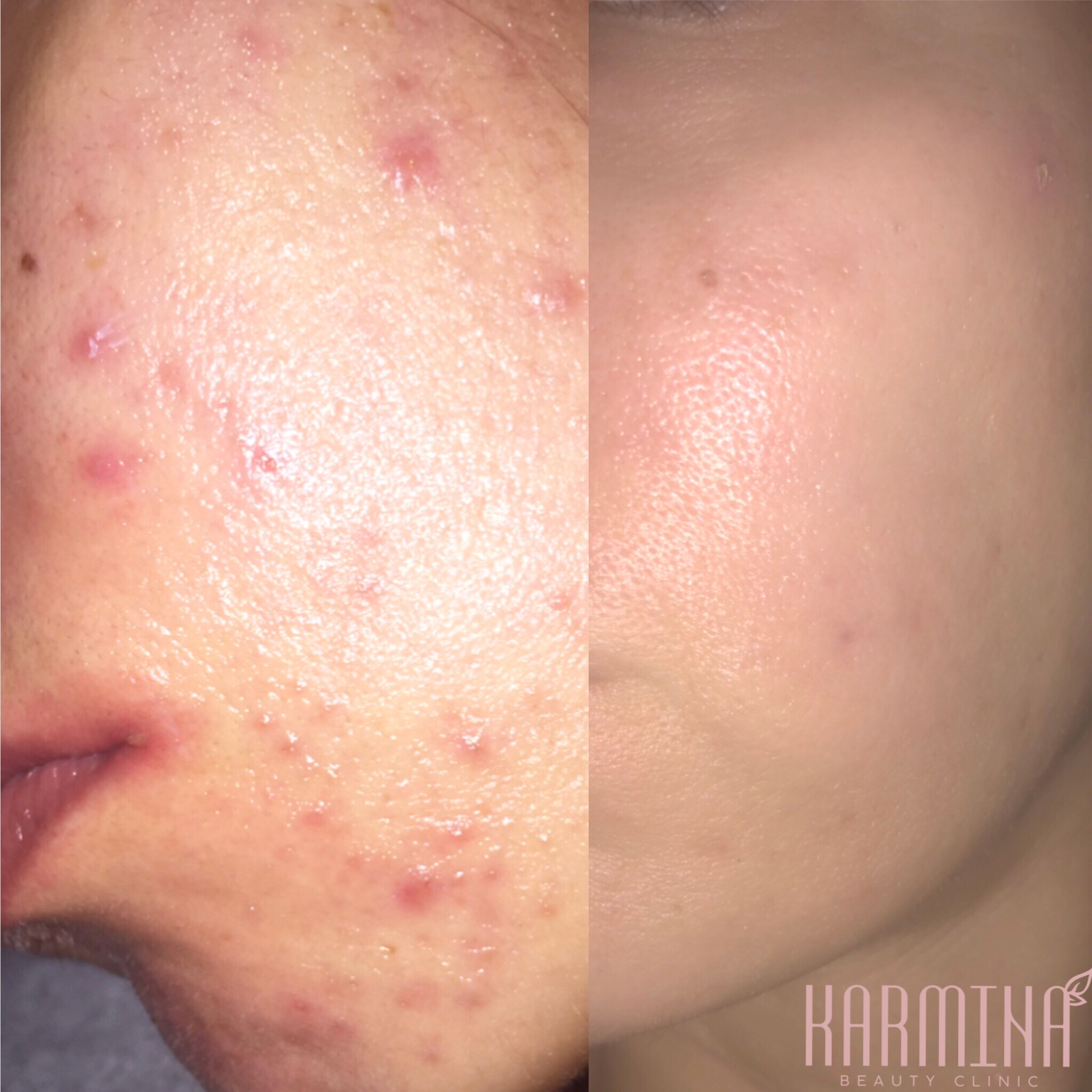Microneedling & Glycolic Acid Peels For Acne Scars Treatment