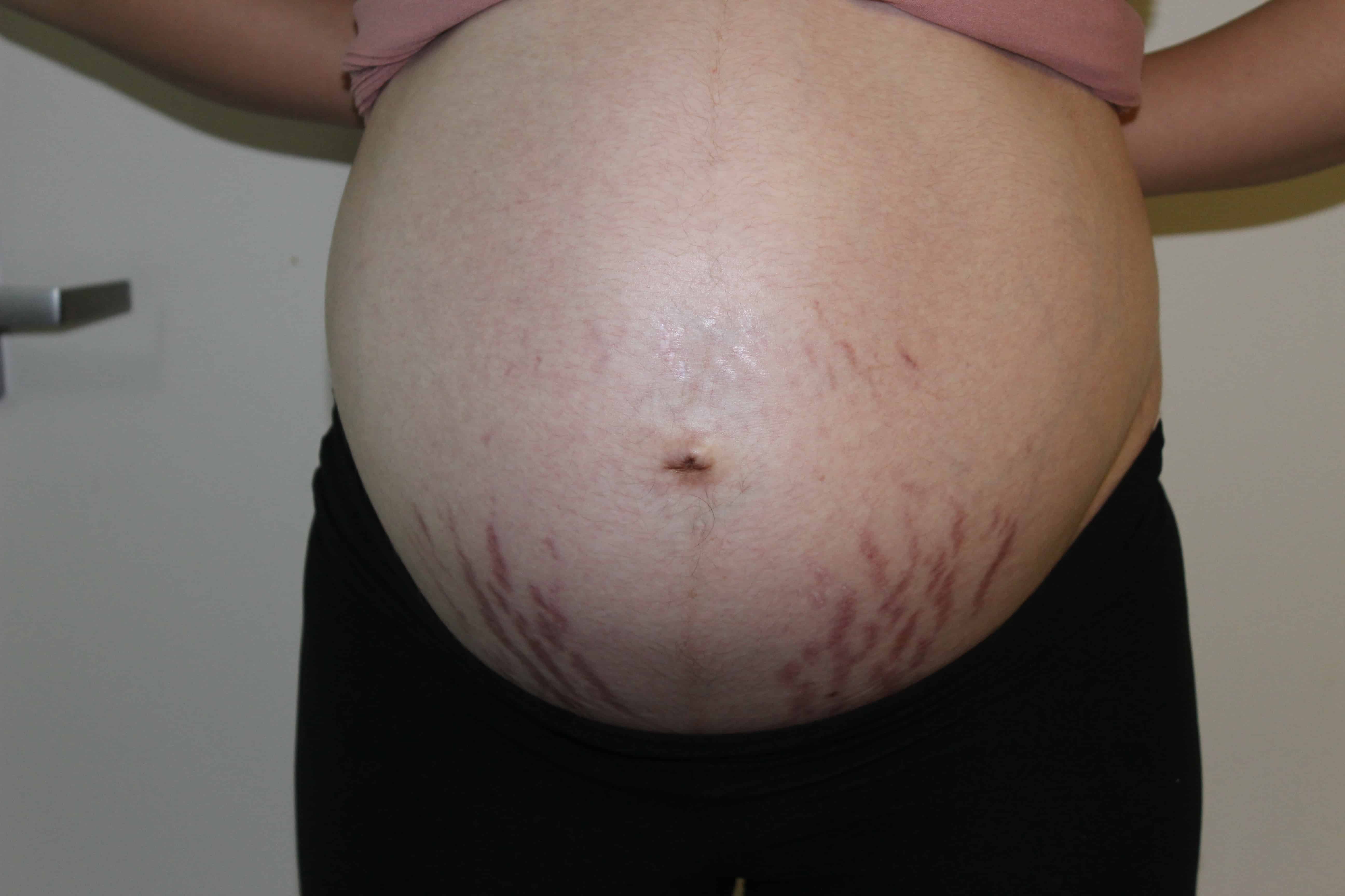 Stretch Marks are Empowering Kateable
