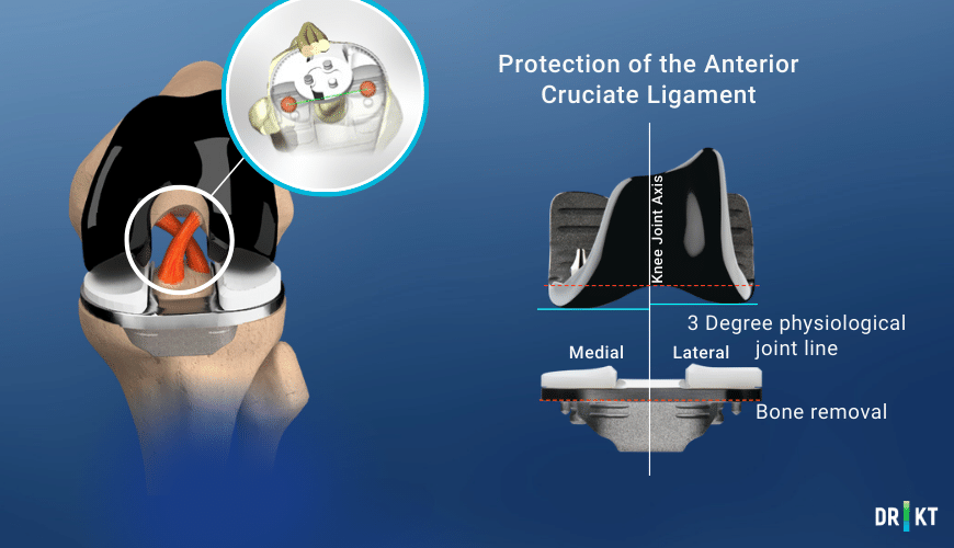 Best Knee Replacement Implant Journey II XR Protecting the Cruciate