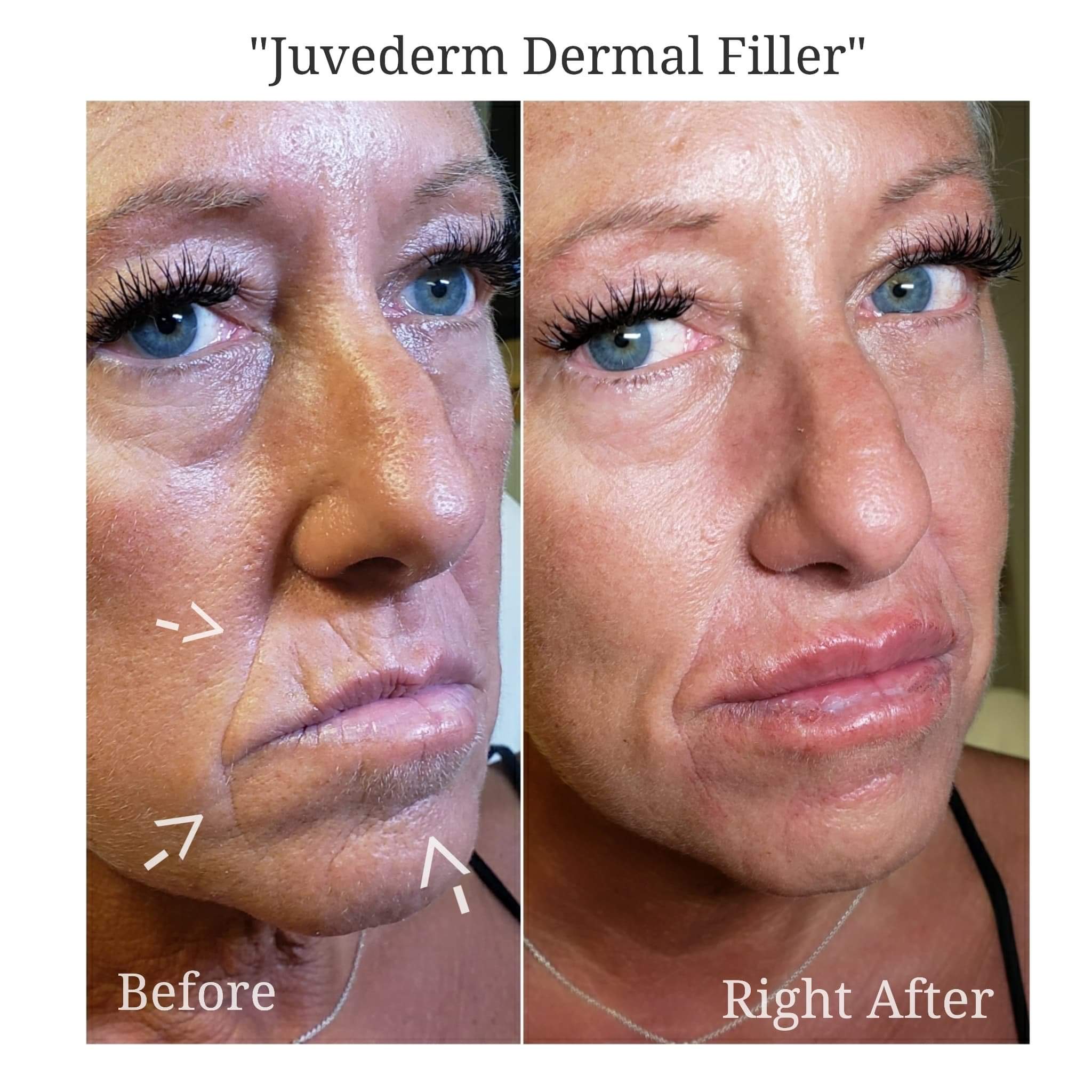 Fillers KBeauty Studio