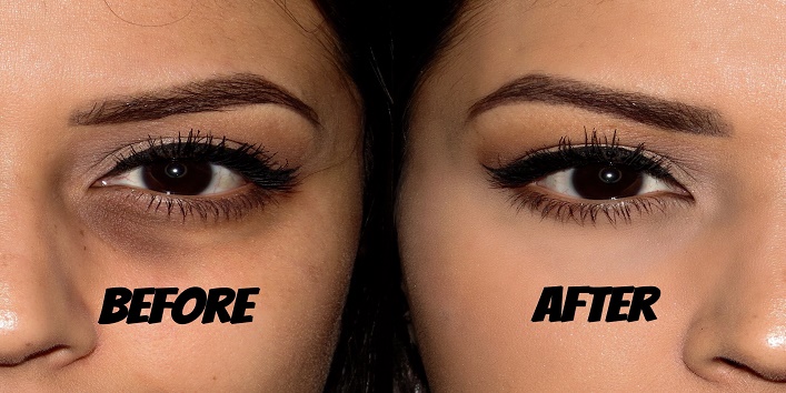 How to Treat Dark Circles with Castor Oil?khoobsurati