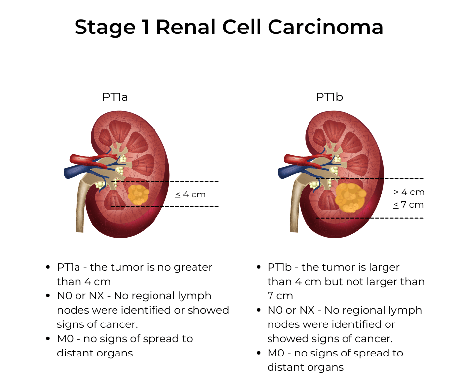 Kidney Cancer Stages KCCure kidney cancer diagnosis stages